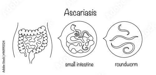 Ascariasis photo