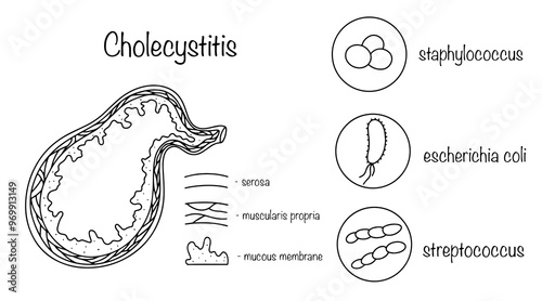 Cholecystitis