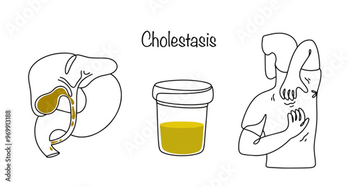Cholestasis