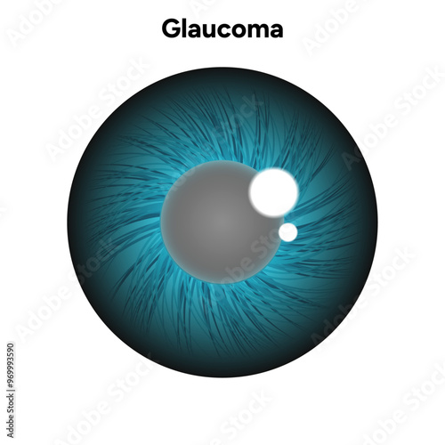 Eye structure defect eye Glaucoma