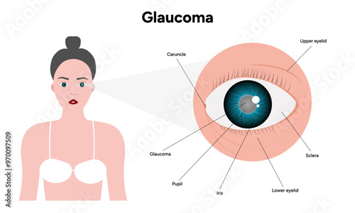 Eye structure defect eye Glaucoma