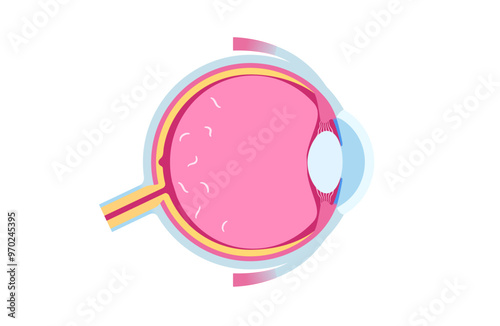 Myodesopsia eye floaters