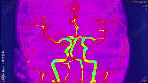 Magnetic resonance images of the brain, MRI of the brain, of a patient with multiple vascular infarctions, Contrast study of cerebral vessels, color animation Seamless Loop photo