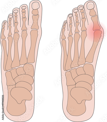 Hallux valgus (Bunion). A common foot disorder. Vector illustration