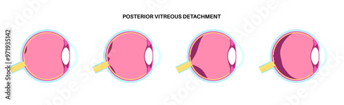 Posterior vitreous detachment
