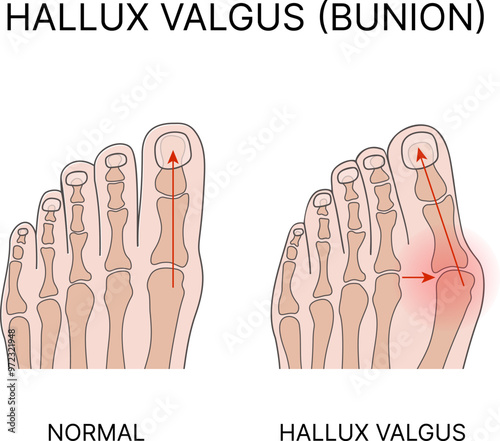 Medical vector illustration of Hallux valgus. Healthy foot and deformation photo