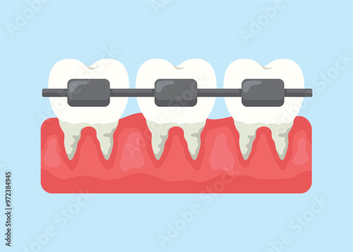 Illustration of the concept of teeth using braces, flat style vector illustration.