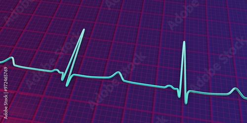 Obraz na plátně ECG of type 3 long QT syndrome, 3D illustration