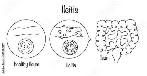 Ileitis