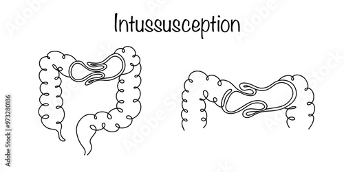 Intussusception