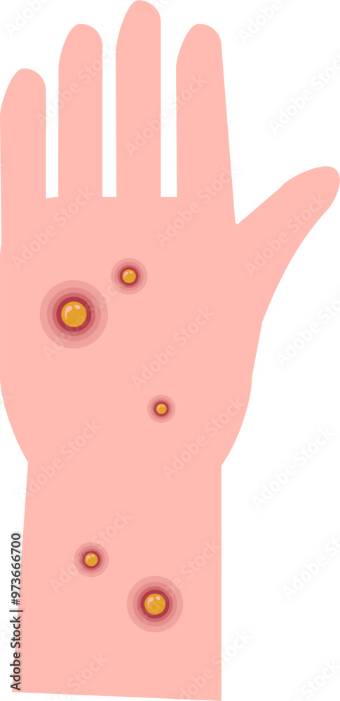 Monkeypox virus Illustration. Mpox virus. Monkeypox virus Illustration. Mpox virus.