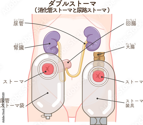 人工肛門、ダブルストーマのイラスト、illustration photo