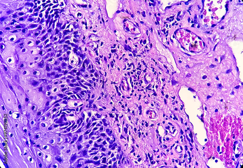 Photomicrograph of histological slide showing Neuroendocrine Cancer. photo