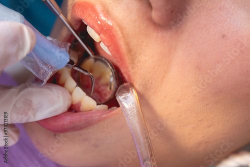 Closeup of an oral prophylaxis or dental cleaning procedure. A dental scaler is being used to remove plaque or tartar from the back of incisors, while a saliva ejector keeps the area dry. photo