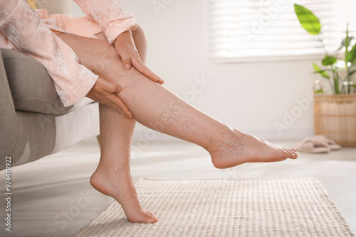 Behang Woman suffering from varicose veins on sofa indoors, closeup