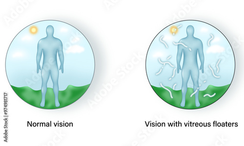 Vision in Normal and Vitreous Floater Eye Condition: A Detailed Science Vector Illustration Highlighting Differences and Visual Impairments