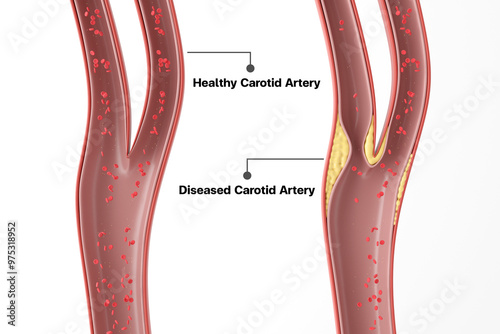 Canvas Print Comparison between healthy and diseased carotid artery