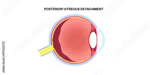Posterior vitreous detachment