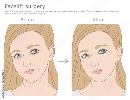 Facial rejuvenation procedure before and after vector illustration. Facelift medical illustration.