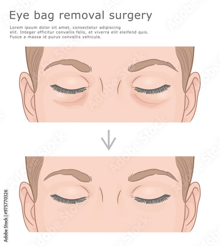 Eye bag removal surgery before and after vector illustration. Facelift medical illustration.