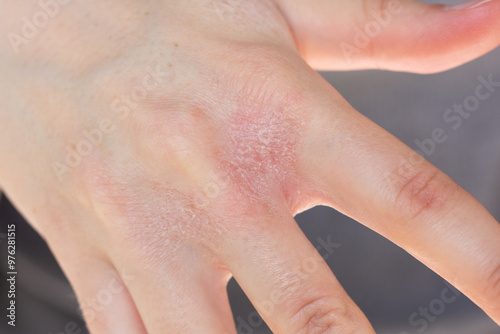 Close-up of a woman’s hands with eczema flare-up between fingers.