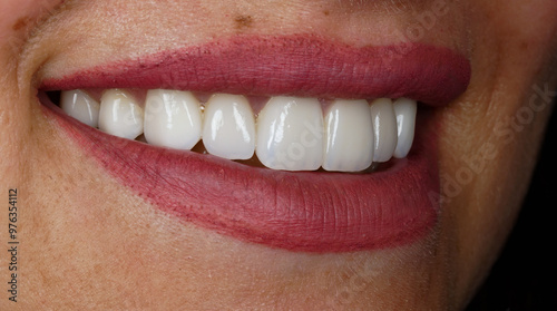 Obraz na plátne Veneers