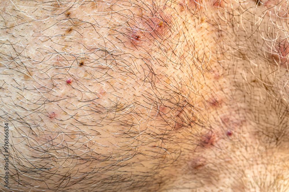 Medical themes: Man with dermatology disease