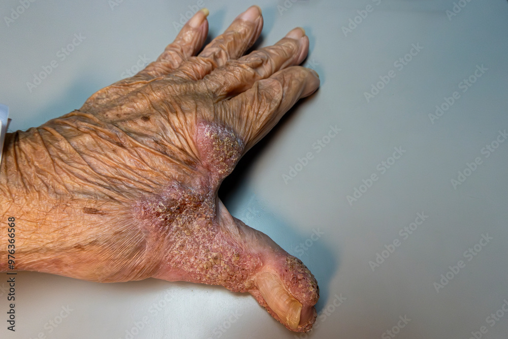 Medical themes: Senior man with funges disease in his left hand.