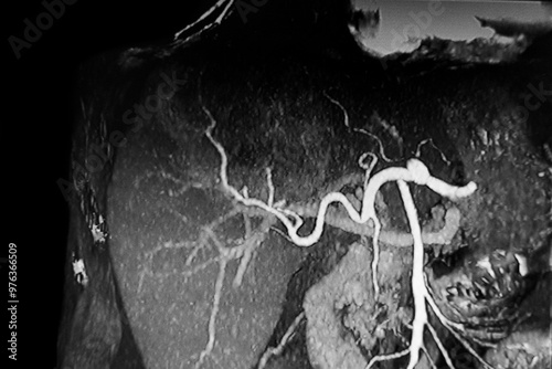 Medical themes: Abdominal angiography of liver tumor