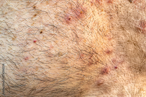 Obraz na płótnie Medical themes: Man with dermatology disease w salonie