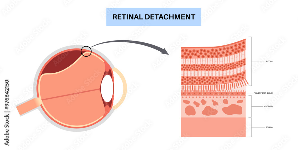 Fototapeta premium Retinal detachment eye disease