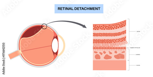 Retinal detachment eye disease