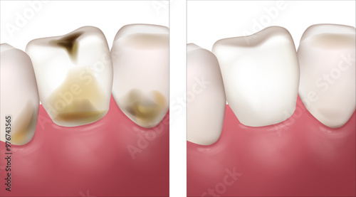 Dental cavities, dental caries, cavities, caries. Tooth decay and normal teeth. Destruction of a tooth by dental caries and disease 