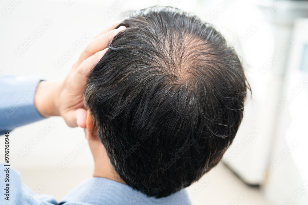 Fototapeta premium Bald in the middle head and begin no loss hair glabrous of mature Asian business smart active office man.