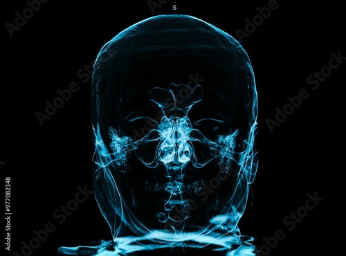 Upper airway, CT scan ,3d head ct scan Coloured 3D computed tomography (CT) scan of the normal human upper airway and paranasal sinuses. 