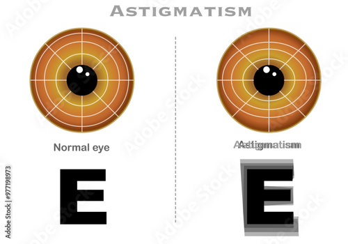 Astigmatism eye, blurred vision. Rotational, vertical, horizontal see. Asymmetry cornea sight circle. Brown iris. focal point. E letter. Vector illustration