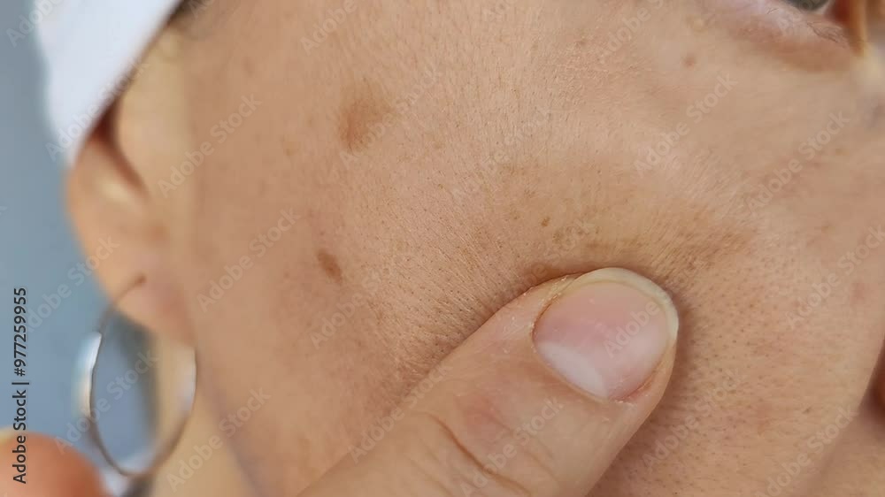 Pigmentation on the face, age spots on the skin from the sun. A woman touches problem stains on her face. Close-up video.