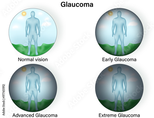 Detailed Science Vector Illustration of Vision in Normal and Glaucoma Eye Conditions, Highlighting Glaucoma Development Stages: Early, Advanced, and Extreme Vision Loss