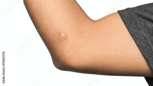 Scar on human skin keloid on elbow.