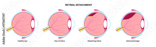 Retinal detachment eye disease