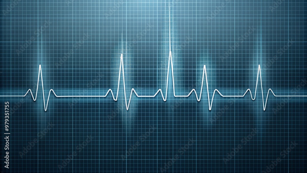 A stylized perspective illustration of an ECG waveform displaying atrial fibrillation, set against a muted blue-gray background with faint grid lines A stylized perspective illustration of an ECG waveform displaying atrial fibrillation, set against a muted blue-gray background with faint grid lines