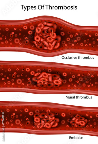 Types Of Thrombosis. Embolus, Occlusive thrombus, Mural thrombus.