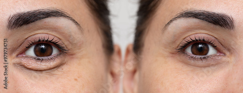 Woman showing before and after eye bags treatment photo