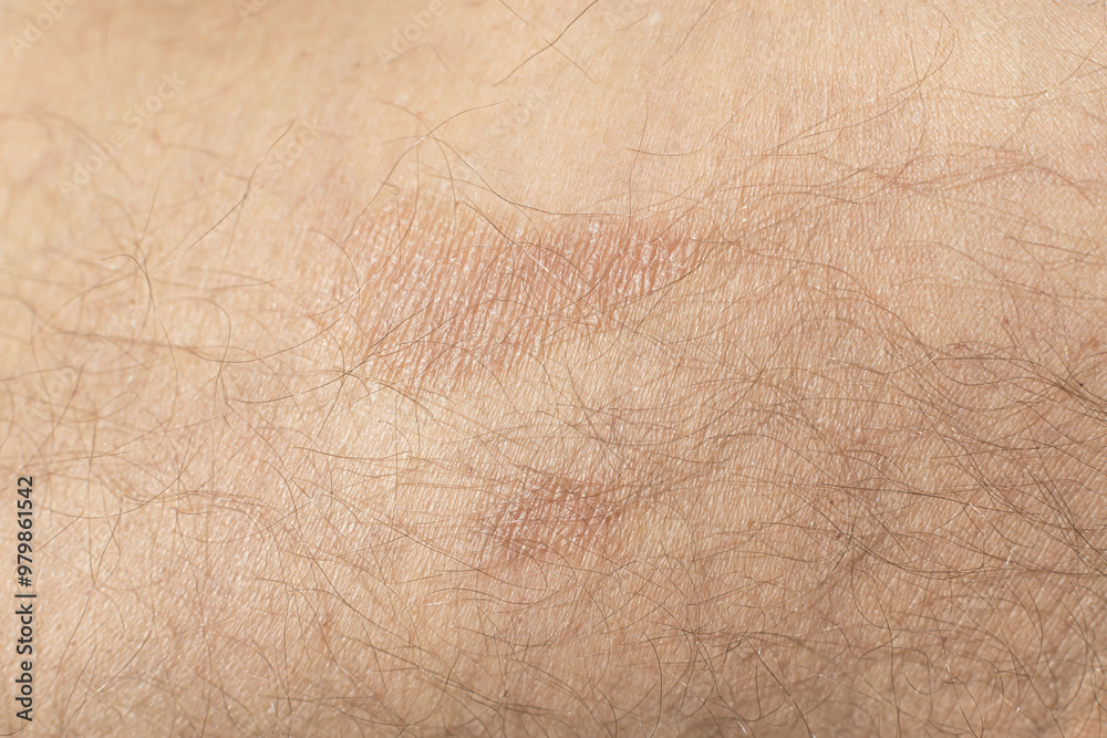 Large plaque parapsoriasis on caucasian man legs Large plaque parapsoriasis on caucasian man legs