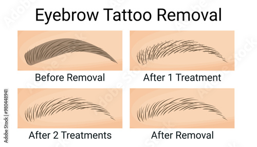 Eyebrow Tattoo Removal, Before and After Results, Vector Illustration