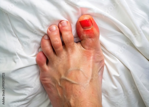 A swollen, red, and inflamed big toe joint, affected by gout, rests on a white bedsheet, showcasing the photo