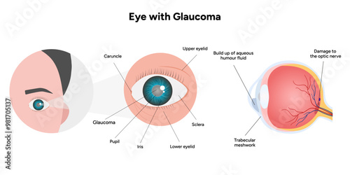 Eye with glaucoma disease, medical infographic with human eye optic anatomy