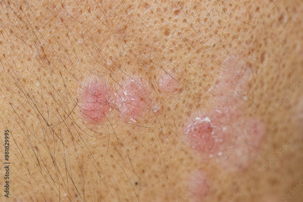Fototapeta premium Scalp fungal infection that causes skin disease at the head, skin on the scalp to flake,Dandruff in the hair, Flaky scalp, Seborrhea. 
