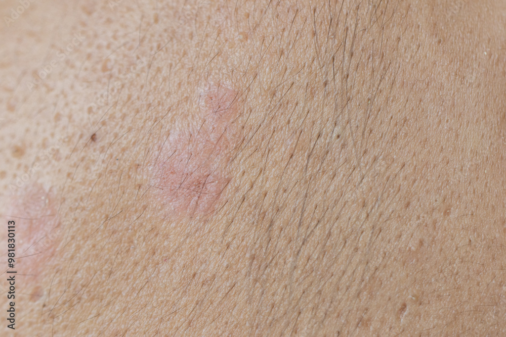 Fototapeta premium Scalp fungal infection that causes skin disease at the head, skin on the scalp to flake,Dandruff in the hair, Flaky scalp, Seborrhea.