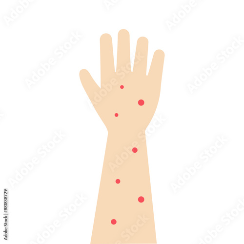 Hand with red rash. Skin problem, healthcare, allergy, treatment, inflection concepts. Flat vector design isolated illustrations.